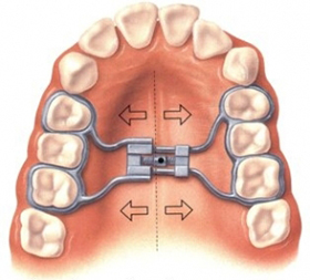 Rapid Palatal Expander - Anderson & Moopen Orthodontics