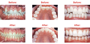 Crowding of Teeth