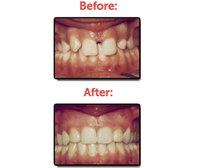 Missing Teeth